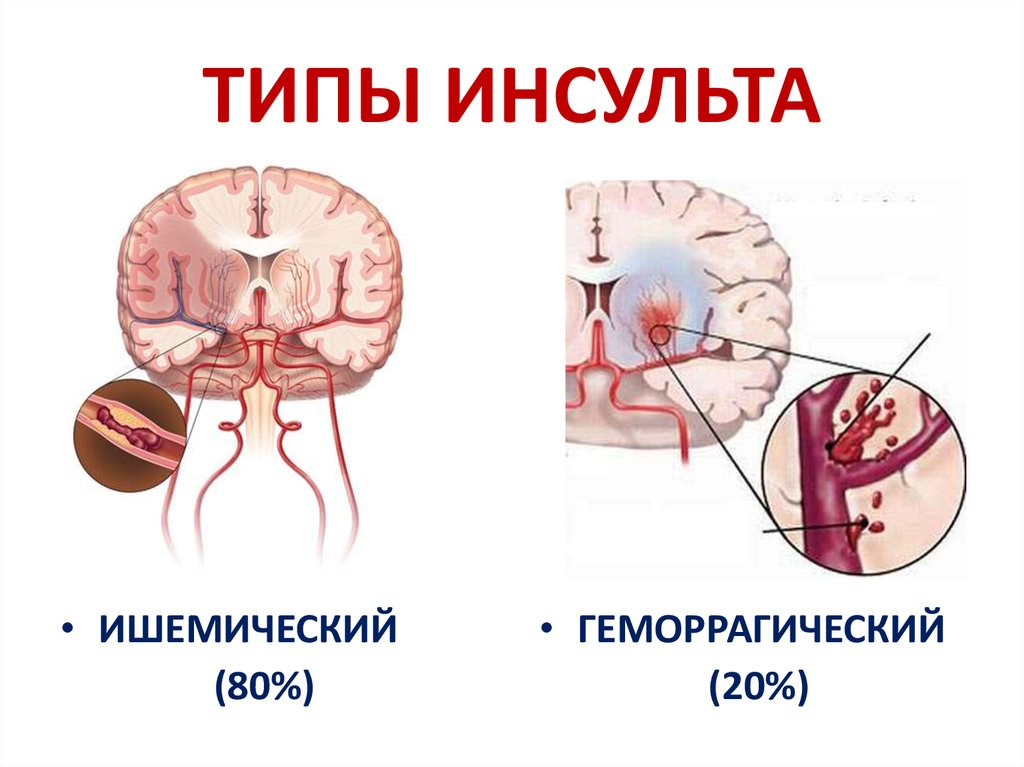Инсульт картинки. Ишемический инсульт головного мозга у пожилых. Ишемический инсульт картинки. Инсульт рисунок.